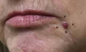 Image result for Pyogenic Granuloma