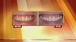 Discover how to stop bleeding gums naturally and permanently without dentist from today. Get Rid Of Receding Gums 6 1 15 Youtube