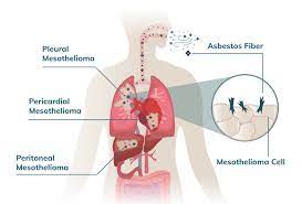 Despite this, pancreatic cancer is among the deadliest types of cancer, which is why it's extremely important to know and recogni. Mesothelioma Com Home Facebook