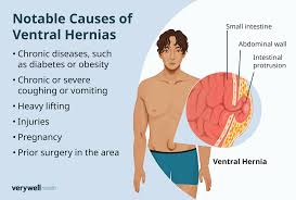 Image result for stomach hernia symptoms