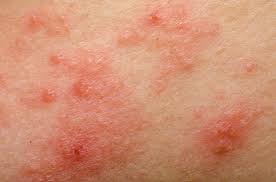 The lymphoma might show up as more than one type of lesion and on different parts of the skin (often in areas not exposed to the sun). Eczema May Reduce Skin Cancer Risk Study Suggests