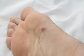 Pinpoint your symptoms and signs with medicinenet's symptom checker. Your Feet Can Outrun Cancerous Tumors Foot And Ankle Centers Of North Houston
