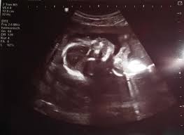 Wann erfahre ich, ob es ein junge oder mädchen wird? Welches Geschlecht Hat Mein Baby Rubbelbatz