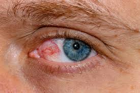 Image result for Eye Pain