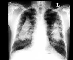 Lung Silicosis With Progressive Massive Pulmonary Fibrosis Radiology Diagnostic Medical Sonography Pulmonary Fibrosis