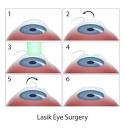What Sets ZEISS SMILE Eye Surgery and LASIK Apart, Including Cost ...