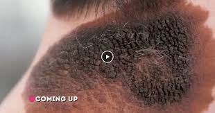 Music for manatees kevin macleod (incompetech.com) licensed. Pimple Popping Videos Youtube