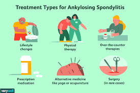 how ankylosing spondylitis is treated