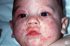 Image result for scabies human children
