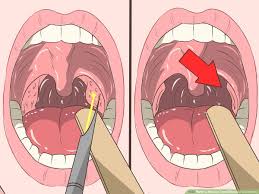 Halitosis associated with tonsil stones is sometimes severe since a common bacteria that contributes to the formation of tonsil stones is known to produce sulfur. 4 Ways To Remove Tonsil Stones Tonsilloliths Wikihow
