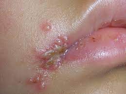 Dann kontaktieren sie uns über unser formular oder per telefon: Herpes Simplex Lippenblaschen Deximed