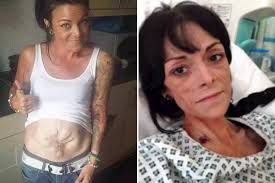 Where is joanna dennehy now? Pregnancy Mum S Intestines Exploded Through C Section Scar Now She Needs Five Organ Transplants To Survive