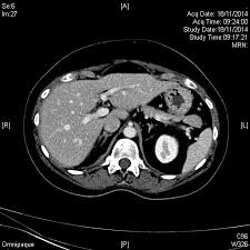 He has ruled out sarcoidosis. Multisystemic Sarcoidosis Important Lessons Learnt From One Of The Great Imitators Bmj Case Reports