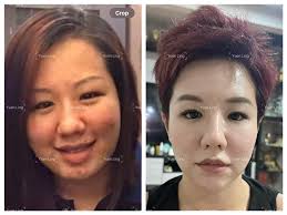 我一直以为「馒化脸」是filler打太多才会有的！ 哪里知道…还有一个东西叫——天生馒化脸（Pillow Face）。 啊对，就是我本人🙋🏻‍♀️  我以前一直都是肉脸、泡泡脸， 别人都说：“哎呀～脸肉肉有福气～baby fat～” 我也信了😌 结果我认真一想—— 哪里有30岁还在baby  fat的人啦 ...