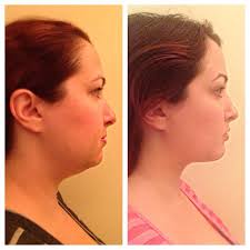 Why I Decided To Get Plastic Surgery My Beauty Bunny Cruelty Free Lifestyle Blog Plastic Surgery My Beauty Surgery