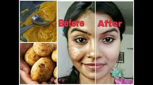 Treatments of melasma include topical, oral, procedural and combination treatments. Remove Dark Spots In Just 7 Days 100 Natural Get Rid Of Uneven Skintone Youtube