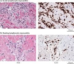 Myocarditis is inflammation of the muscle of the heart, and pericarditis is inflammation of the tissue that forms a sac around the heart. Myocarditis And Inflammatory Cardiomyopathy Current Evidence And Future Directions Nature Reviews Cardiology