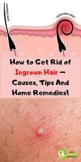 Unfortunately, when hair follicles curl and grow back into your skin after shaving, annoying red bumps can be the frustrating result. PreambulÄ— Diakritinis Ismatos Ingrown Leg Hair Treatment Jimstart Com