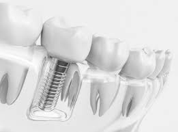 The main barrier to more people getting dental implants is the expense; The Pros And Cons Of Dental Implants Dental Crowns Aurora Dental