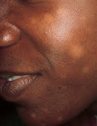 Pityriasis alba on the cheek. White Areas On The Face Of A Teenager Page 2 Of 2 Clinical Advisor