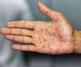 We did not find results for: Ø£Ø¹Ø±Ø§Ø¶ Ù…Ø±Ø¶ Ø§Ù„Ø²Ù‡Ø±ÙŠ Ø¹Ù†Ø¯ Ø§Ù„Ø±Ø¬Ø§Ù„ ØªØ¹Ø±Ù Ø¹Ù„ÙŠÙ‡Ø§ ÙˆÙŠØ¨ Ø·Ø¨