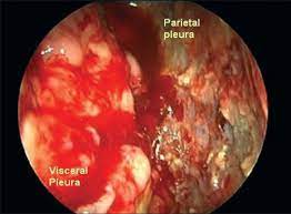 If you have been diagnosed with adenocarcinoma cancer, you have a cancer that developed in one of the glands that lines the inside of your organs. Medical Thoracoscopy Showing Advanced Stage Malignant Mesothelioma With Download Scientific Diagram