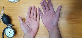 أسباب ازرقاق كف اليد موضوع