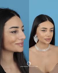 3 months after Rhinoplasty (Thick Skin Rhinoplasty) My dear patient  @cvetelinnavl came from Bulgaria🇧🇬 for me. I had previously performed  rhinoplasty surgeries