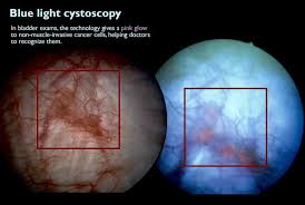 Webmd explains what it is and what factors put you at risk. From Out Of The Blue Comes A Better Bladder Cancer Detector Newsroom