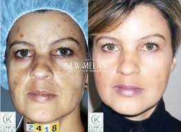 ✨ ¡Dile adiós al melasma con NewMelan del Dr. Eduardo Krulig! ✨ ¿Las  manchas afectan tu piel y tu confianza? Con NewMelan del Dr. Eduardo  Krulig, recupera la belleza natural de tu