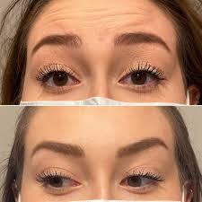 Some people will get the tight sensation as a result of the muscle paralysis. Botox In Austin Tx Viva Day Spa Med Spa Natural Looking Results