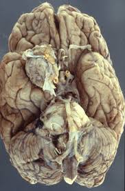 A frontal lobe brain tumor is a mass that develops in the front part of the brain and may or may not be cancerous. Brain Tumors General