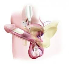Image result for Penile Prosthesis