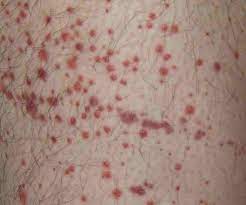 Sintomi di un tipo di leucemia: Purpura Wikipedia