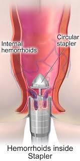 Your doctor may err on the side of caution, and keep your staples in longer if there is any concern that the wound is not healed enough to remove this support. Stapled Hemorrhoidopexy Wikipedia
