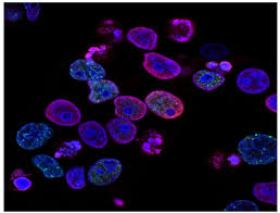 How do you tell the difference between colon cancer and semicolon cancer? Stomach Cancer Treatment Hospital In India Denvax