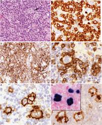 Angioimmunoblastic t cell lymphoma (aitl) presents in older patients and the median age at diagnosis is approximately 60. Angioimmunoblastic T Cell Lymphoma With Hodgkin Reed Sternberg Like Download Scientific Diagram