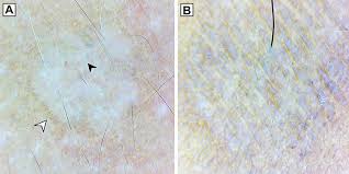 Instead it would be from the moisturizing effect. Dermoscopic Pattern Of Pityriasis Versicolor Ccid