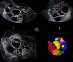 Hi, i have had breast pain and swelling for months, i figured it was a menopause or hormone thing, due to my hysterectomy 8yrs ago. Ovarian Cysts What Are They Symptoms And Treatment Forum Instituto Bernabeu