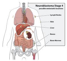 A yellow discoloration of the skin and whites of your child's eyes due to an abnormally high level of bilirubin (bile pigment) in the bloodstream. Department Of Surgery Pediatric Cancer