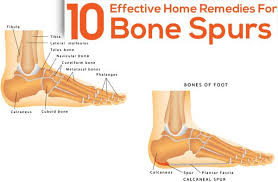 How To Heal Bone Fractures Faster Bone Spurs Home Remedies Heal Spurs