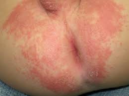 Otorrinoweb Dermatitis Perianal
