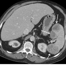 Old Granulomatous Disease Axial Ct Image Shows Multiple Small High Download Scientific Diagram