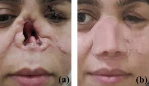 The appearance of the patient who has nose loss (a) without prosthesis...