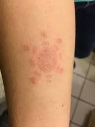 A severe allergic reaction to his body art, a new case report shows. Chemical Burn From Black Henna Tattoo Picture Of Omni Cancun Resort Villas Tripadvisor