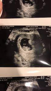Gender Blood Test Help September 2018 Babies Forums What To Expect