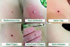 Bei vielen vorher nachher vergleichen einer haartransplantation kann man auf den ersten blick nicht einmal sicher sagen. 44 Sonstiges Ideen Gesundheit Gesundheit Und Fitness Gesundheit Und Wohlbefinden