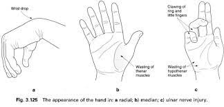Appearance Of Hand Muscle Wasting In Nerve Injuries Hand Therapy Emergency Medicine Occupational Therapy Assistant