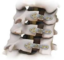 Gallery™ Laminoplasty Spine System – Highridge Medical