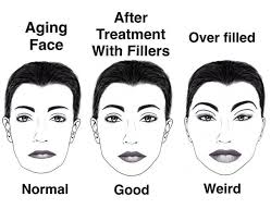This trend of looking overdone has made others scared to try fillers and/or  Botox. Botox and fillers injected appropriately should only enhance natural  features, not overpower the face to where someone doesn't